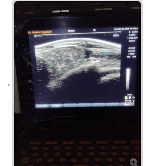 Can sheep B-ultrasound machines diagnose metritis in ewes?