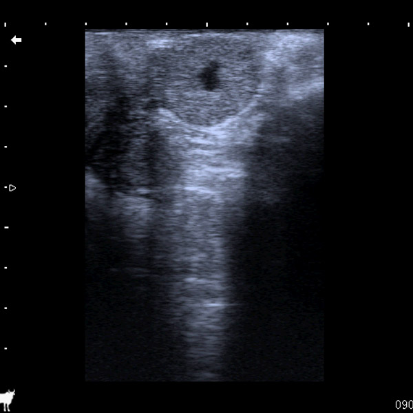 cavitary corpus luteum