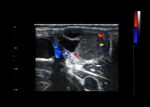 What is the Difference Between Doppler and B Mode Ultrasound?